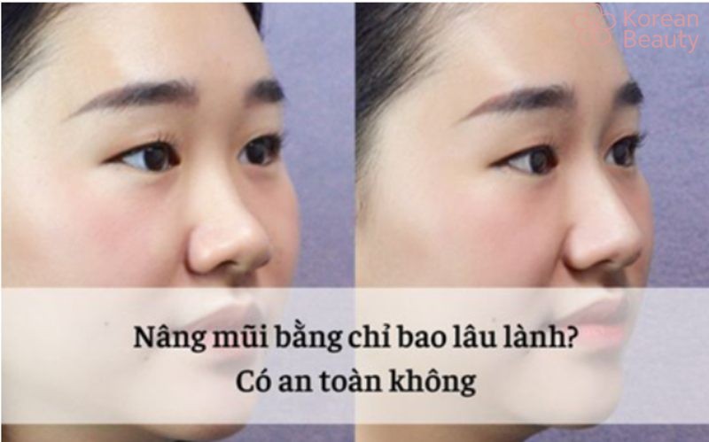 Những vấn đề liên quan đến nâng mũi bằng chỉ giữ được bao lâu?