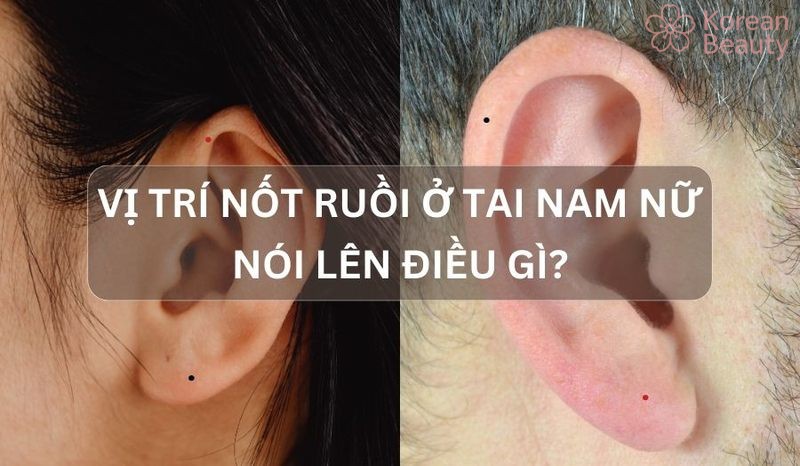 Những vấn đề liên quan đến nốt ruồi tai