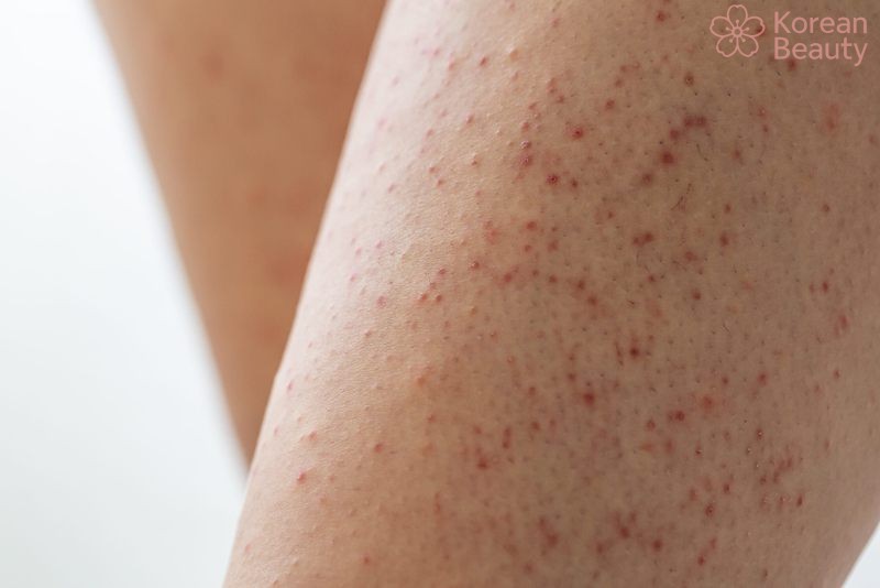 Những vấn đề liên quan đến tình trạng da nổi đốm nâu không ngứa